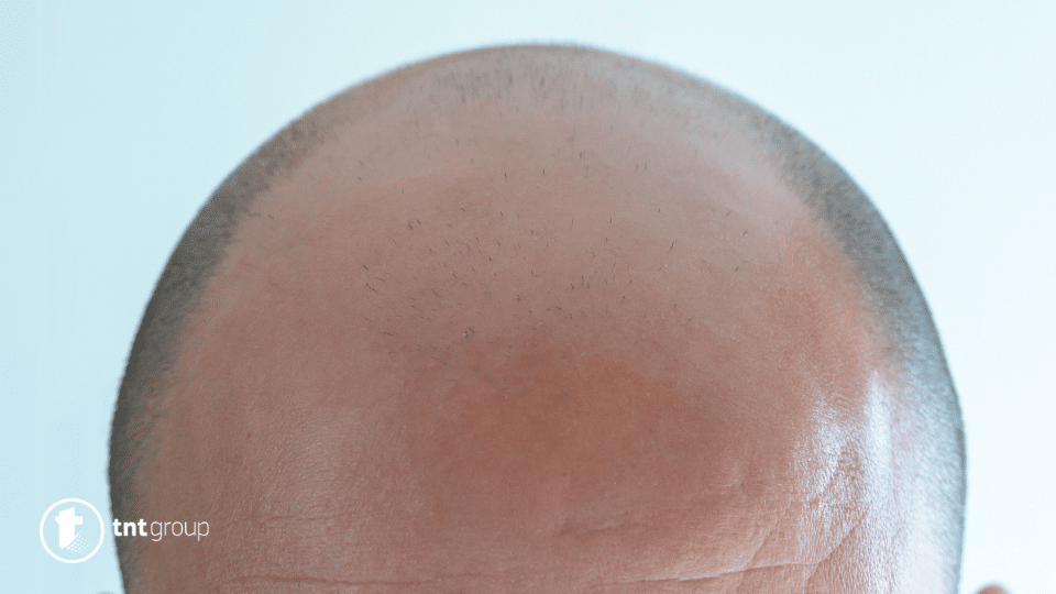 bald and baldness dream meaning and symbolism